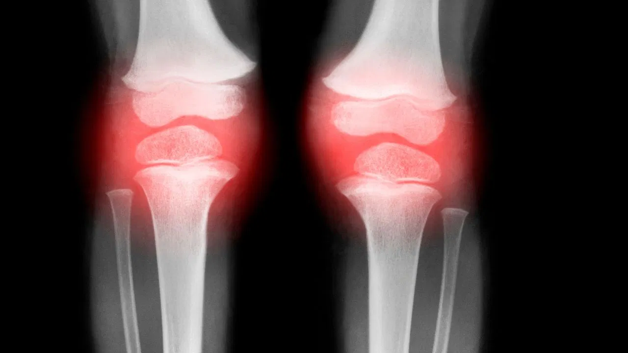 Viņi noskaidroja, kāpēc osteoartrīta gadījumā tiek iznīcināta skrimšļaudu audu un kā to atjaunot.