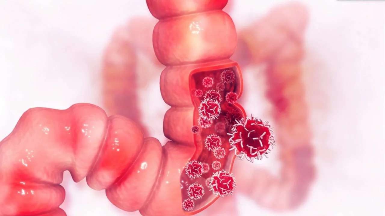 Tas izraisa zarnu perforāciju un diabētu. To pievieno lielos daudzumos.