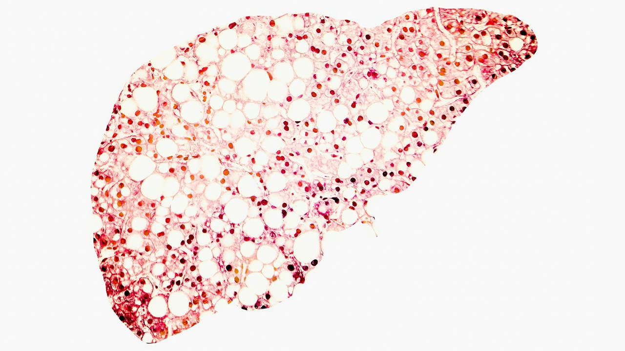Vai varu lietot žāvētu gaļu, ja man ir aknu taukainā distrofija?
