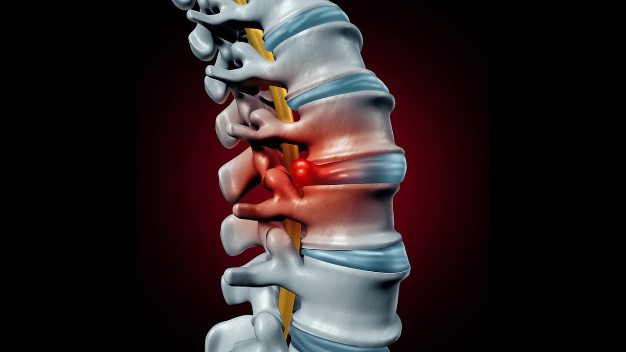 Kā notiek starpskriemeļu disku reģenerācija, lai ārstētu sāpes jostasvietā?